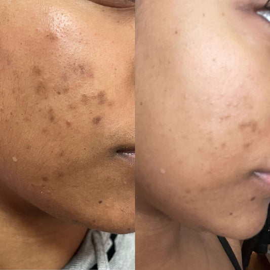 Pimples Acne Eczema and Discolouration wipe out rub