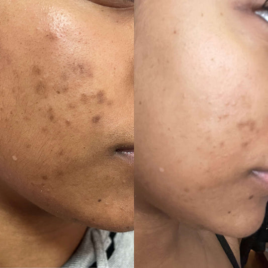 Pimples Acne Eczema and Discolouration wipe out rub