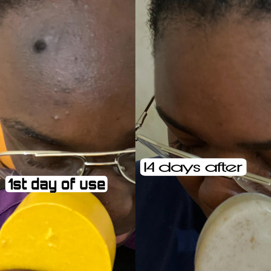 Dusk till dawn acne/ pimples/ eczema/ discolouration face renewal soap